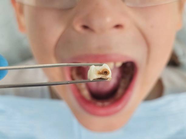 Best Broken Tooth Emergency  in Ller, WA